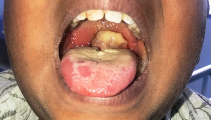 Warning to Nigerians: FG Raises Alarm as Diphtheria Cases Surge to 798